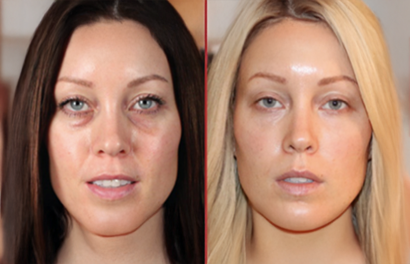 Regenerative hair restoration before and after