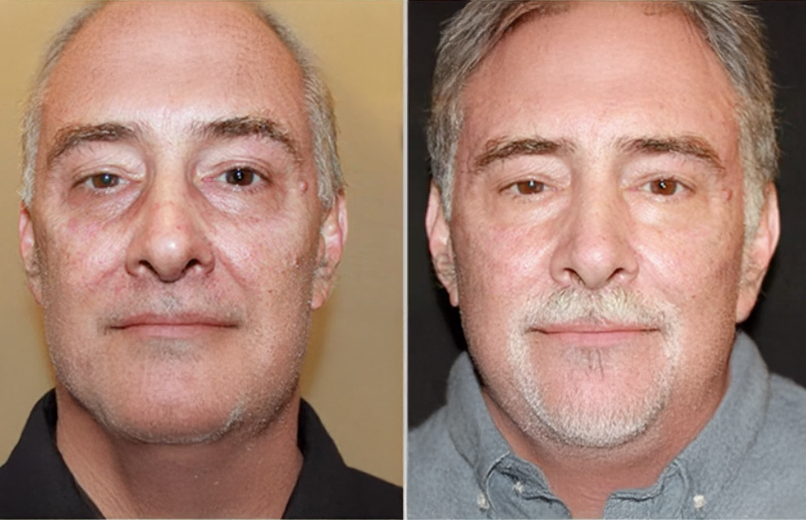 Facial rejuvenation transformation